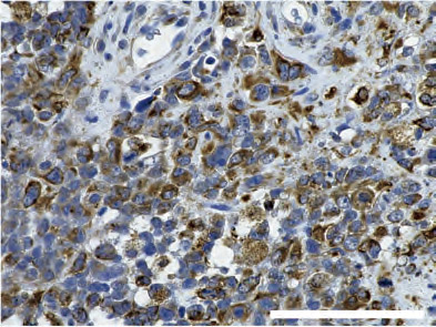 【図3】転移性脳腫瘍患者の免疫染色標本